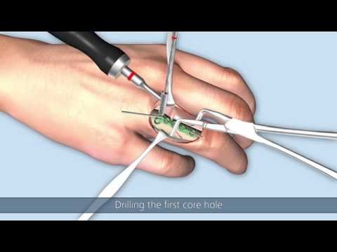 Linos – Oblique fracture of the proximal phalanx