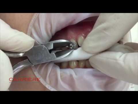 Carriere® Motion™ Debonding Instructions by Dr. Luis Carriere