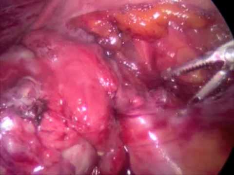 Large Dermoid Cyst with Abdominal Pain