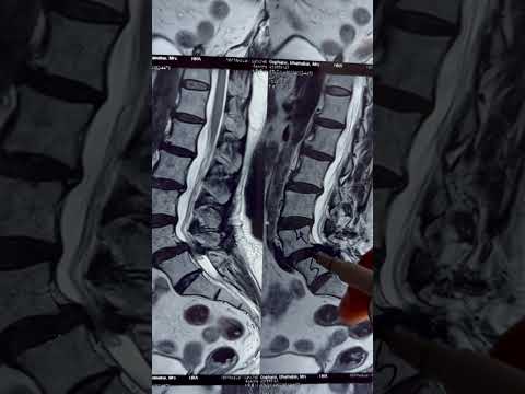 What is Spondylolisthesis what surgery is done?