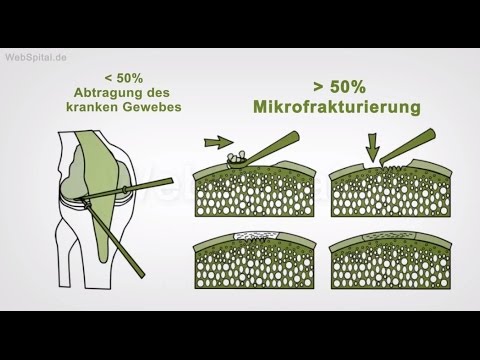 Schlammbehandlung mit Hernien der Band Beste Salbe für Gelenkschmerzen Forum