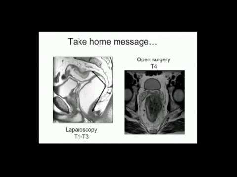 Escisión mesorrectal total laparoscópica para el cáncer de recto