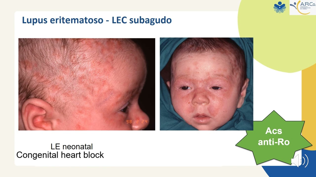 Sessão multidisciplinar - A pele nas doenças reumáticas