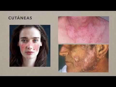 Systemic lupus erythematosus