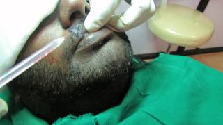 preview picture of video 'Mustache Hair Transplant in India'