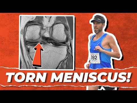 How I Returned to Running Post Meniscus Tear