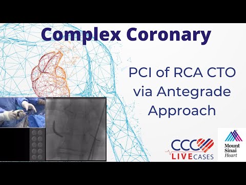 PCI of RCA CTO via Antegrade Approach - CCC Live Cases August 2017