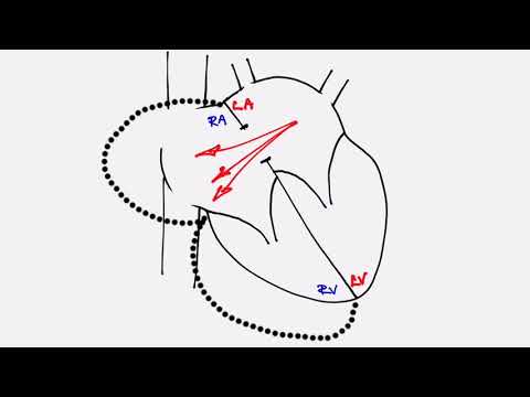 Adult Congenital Heart Disease: Atrial Septal Defect
