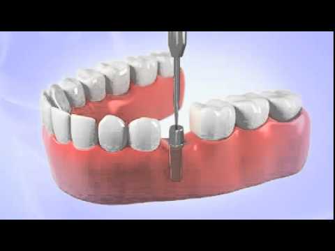 download lagu mp3 mp4 Dentist Diamond Bar Ca, download lagu Dentist Diamond Bar Ca gratis, unduh video klip Dentist Diamond Bar Ca