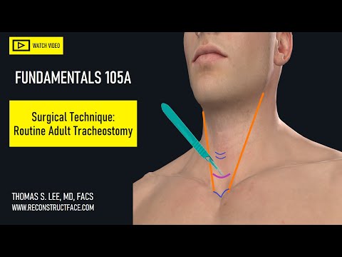 Routine Adult Tracheostomy Surgical Technique Basics: Must-Know to Avoid! [105A] Didactic