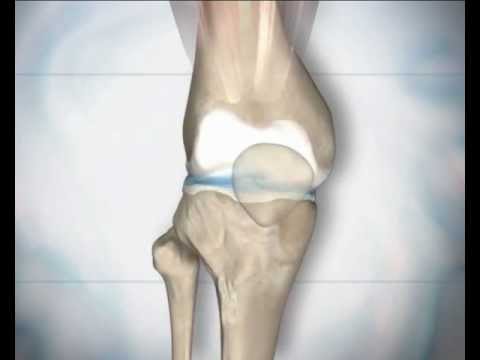 Ce vitamine să luați cu artroza articulației genunchiului