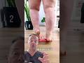How to Treat Leg Swelling