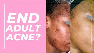 How to Get Rid of Pimples in Black Skin (Best Pro Treatments)!
