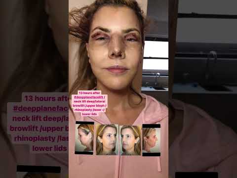 Watch Video: 13 Hours Post #Deeplanefacelift | Dr. Rizk