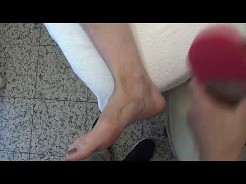 [Eng Sub] 047. Plantar fasciitis and hallux valgus. A 20-year condition healed after 5 sessions.