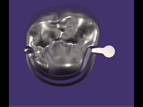 exocad 6547 Gratis Geschiebe + gefräste Lager + Interlock