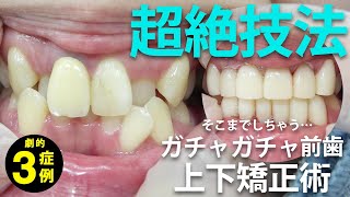 【セラミック矯正】ガチャガチャ前歯→嚙み合わせまで超絶変身！！サムネイル