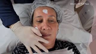 Ultraformer III Full Face - Combate a Flacidez!!💪😍