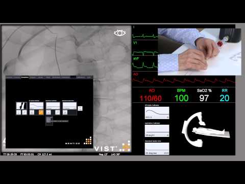 Primary PCI AMI 1 Alternative 1 - Mentice VIST C