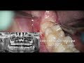 Horizontal semi-impacted wisdom tooth (sonic vs piezosurgery) - Dr. Fabio Cozzolino | Zerodonto