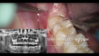 Horizontal semi-impacted wisdom tooth (sonic vs piezosurgery) - Dr. Fabio Cozzolino | Zerodonto