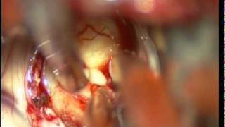 preview picture of video 'colloid cyst 3rd ventricle TRANS CORTICAL microsurgical total excission-dr suresh dugani,HUBLI/INDIA'