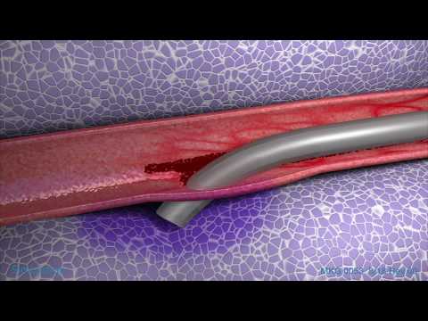 Peripheral IV Infiltration Animation