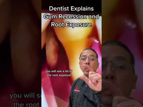 Treatment Plan For Excessive Gum Recession & Root Exposure | In Office to Hands On Dental Training