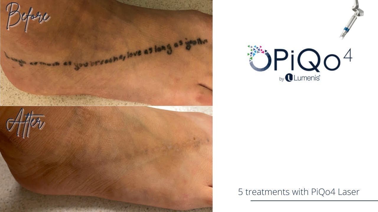 Ankle Wave Tattoo Removed with 3 Sessions of PiQo4 Laser Tattoo Removal for  Asian American Woman Before  After Photos New Jersey  Reflections Center