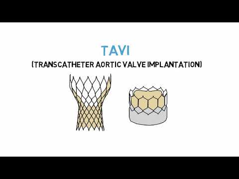 CVSKL Transcatheter Aortic Valve Implantation (TAVI) Education Video