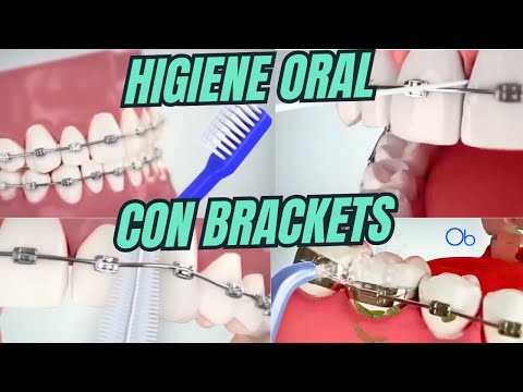 Higiene Oral con Brackets