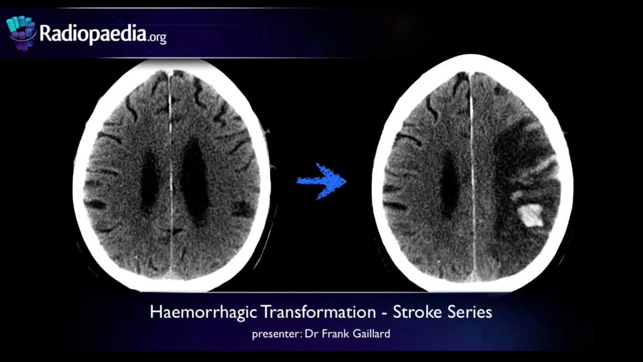 Stroke: Haemorrhagic transformation - radiology video tutorial (CT, MRI)
