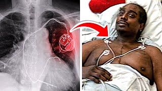 Man With Two Hearts Survives Double Heart-Attack