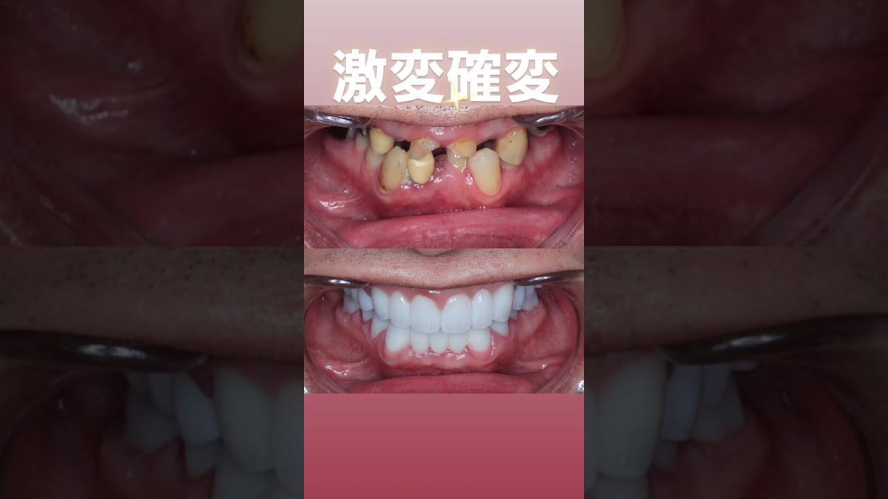 全24歯今クリアートダイヤモンドセラミック、インプラント２本併用です。全てをイチから再構築して、なお最も美しくを追求していきました。#セラミック#インプラント#ダイヤモンド今井院長