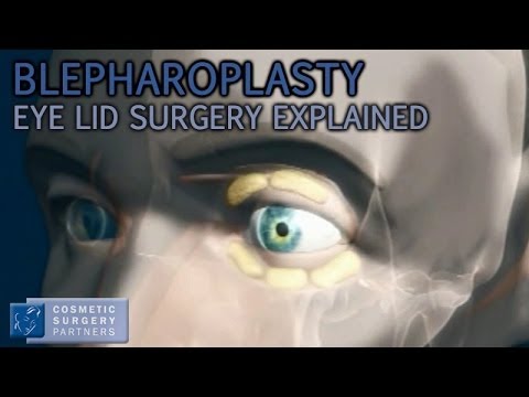 Blepharoplasty Eyelid Surgery Explained - video animation