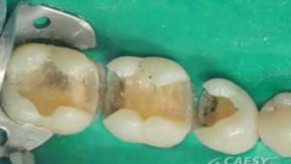 Cerec One Visit Crowns