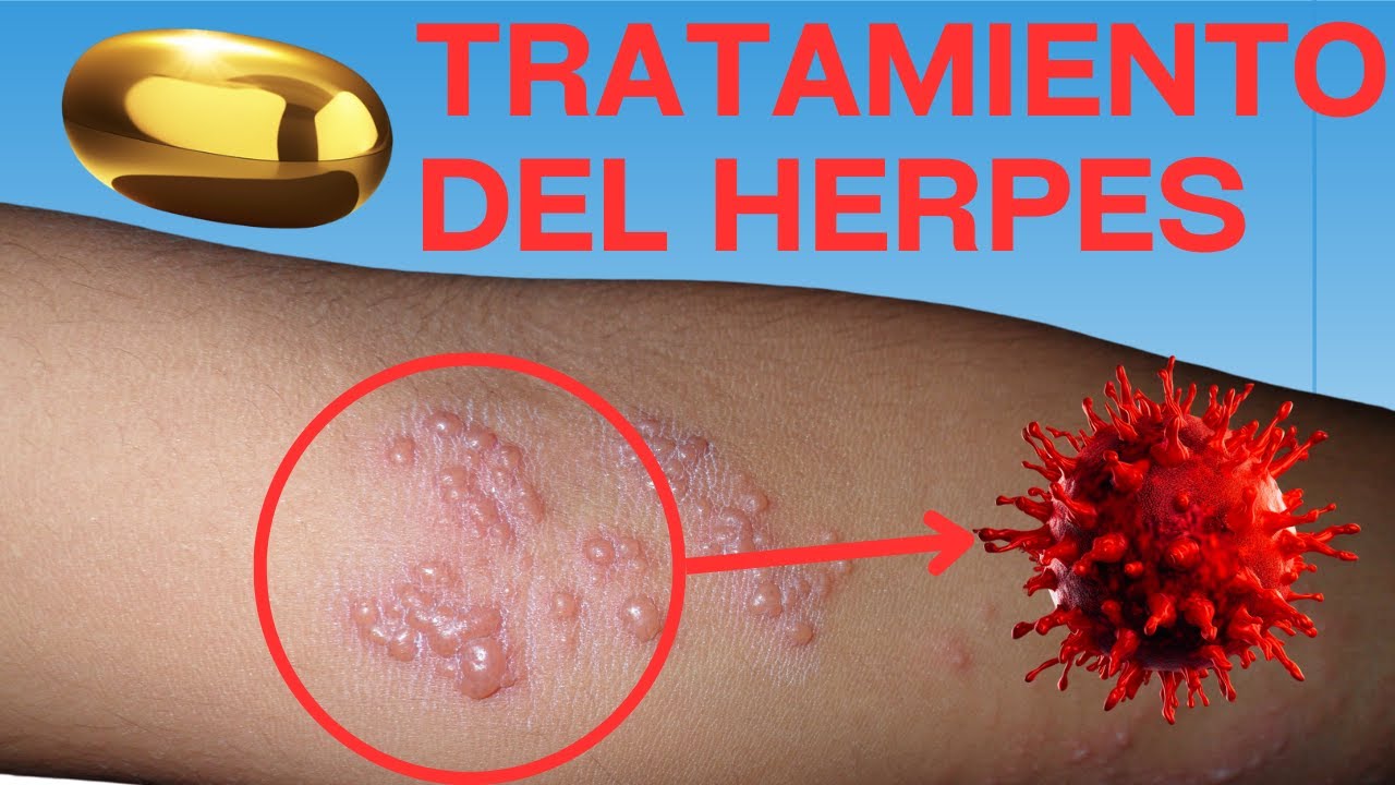Tratamiento del herpes