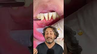 ¿Tienes SENSIBILIDAD después de una LIMPIEZA DENTAL Descubre la CAUSA de tus dientes destemplados