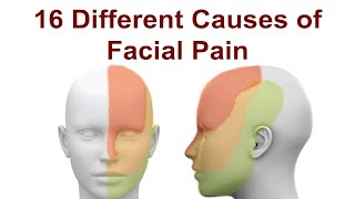 16 Causes of Facial Pain and Treatment Strategies