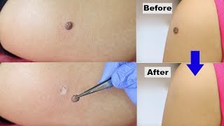 I got my mole removed in 5 minutes | Everything you need to know about getting moles removed
