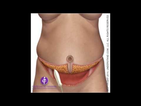 Abdominoplasty Excellence in Colombia: Complete Tummy Tuck Procedure Guide