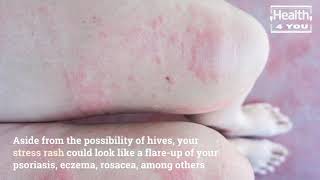 What Is a Stress Rash How to Treat One