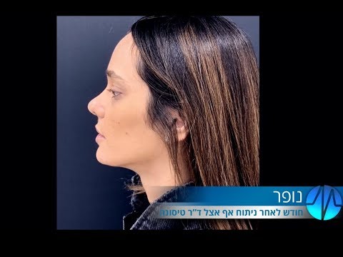 ניתוח אף מתקן של נופר אצל ד