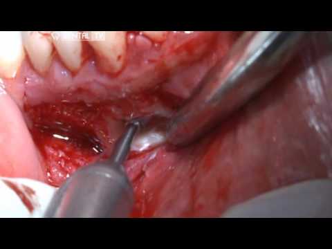 Respiratory papillomatosis vocal folds