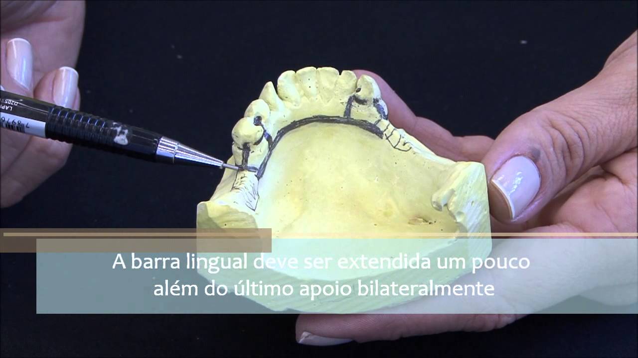 Redelineamento de PPR