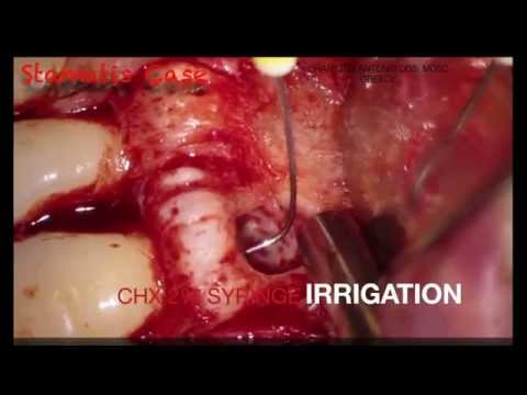 Minimal Invasive Management of the Necrotic Immature Root