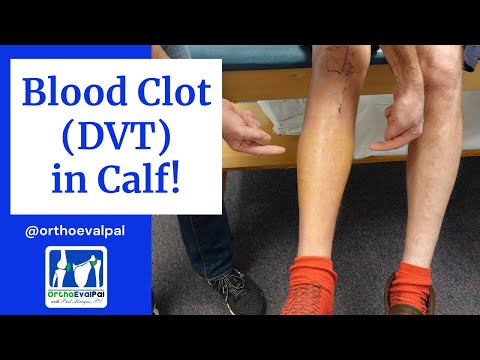Blood Clot (DVT) in  the Calf! Actual Patient Presentation