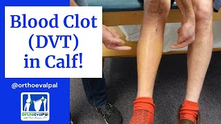 Blood Clot (DVT) in  the Calf! Actual Patient Presentation