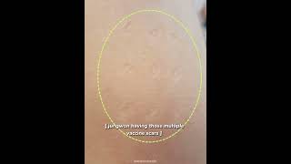 Download lagu jungwon having those multiple vaccine scars #enhypen #jungwon mp3