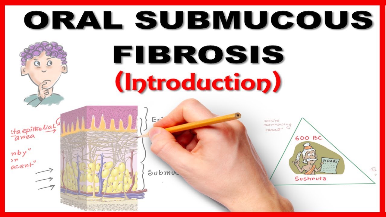 Oral Submucous Fibrosis (OSMF) Introduction